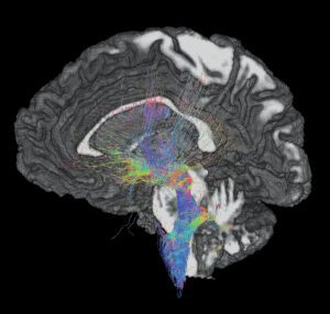 MRI imaging of the brain